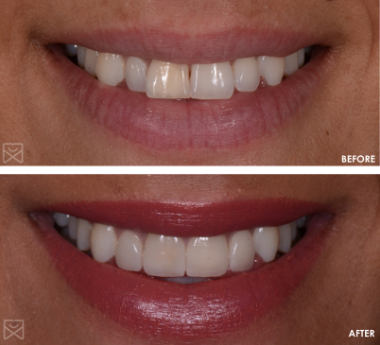 Before and After, Case 1 | Dental Veneers