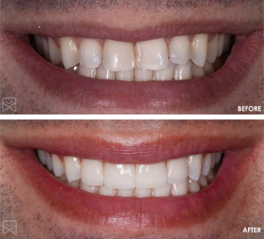 Before and After, Case 2 | Dental Veneers