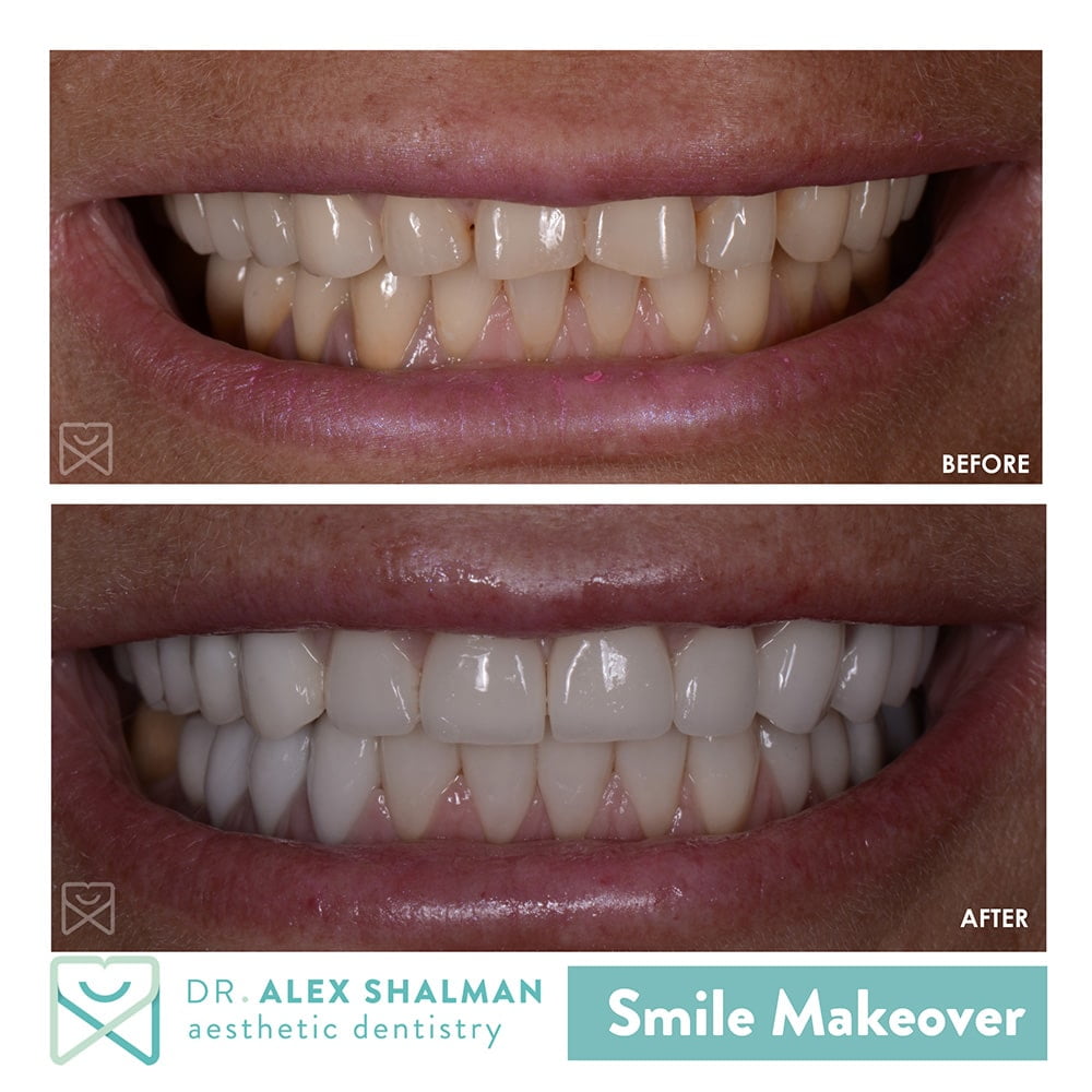 Smile Makeover - Before / After Case 1