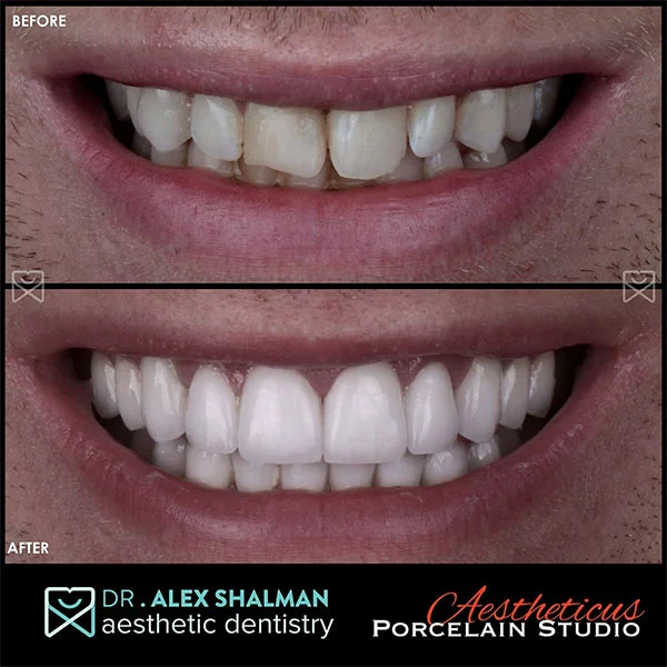 smile makeover nyc dentist