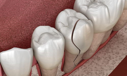 What Does It Mean If Your Tooth Hurts?