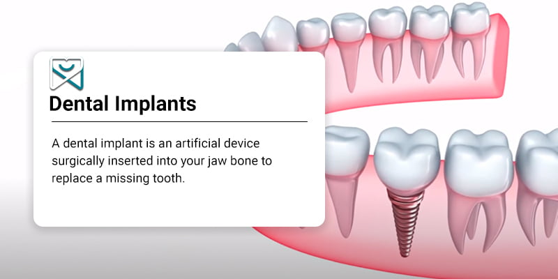 Dental Implants