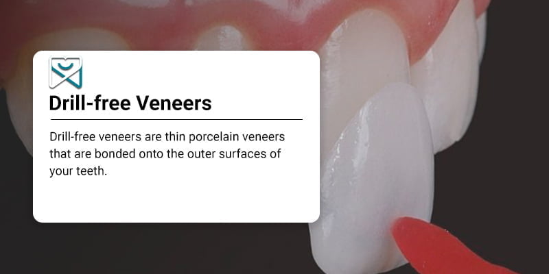 Drill-free veneers