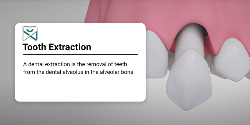Tooth Extraction in Manhattan