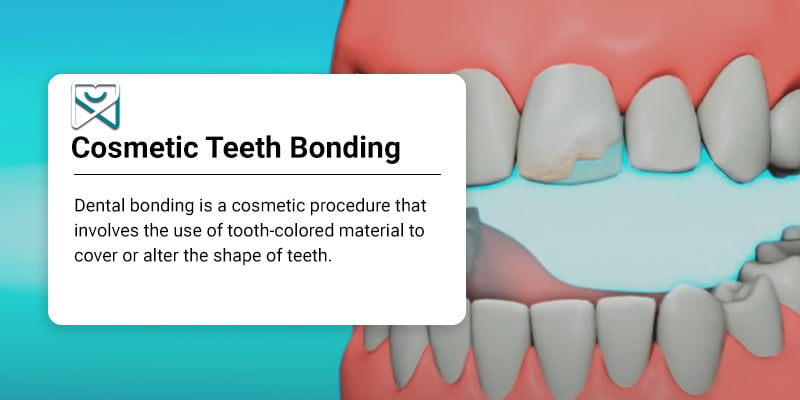 NYC Tooth Bonding