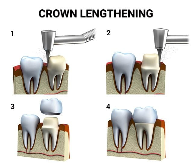 Crown lengthening procedure