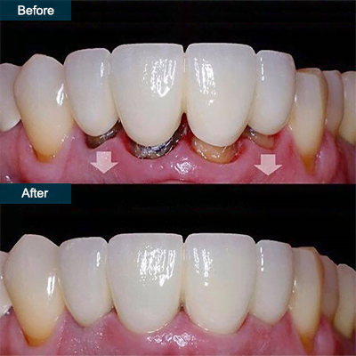 Dental Crown NYC
