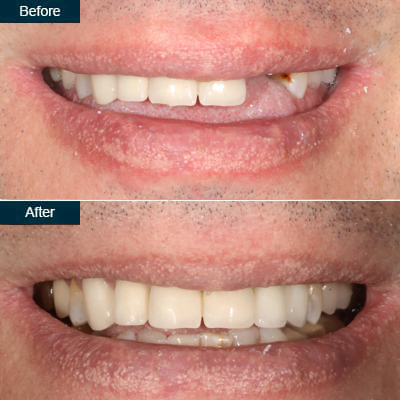 Dental Implant in Lower Manhattan - Before and After