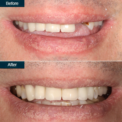 Dental Implant Before and After