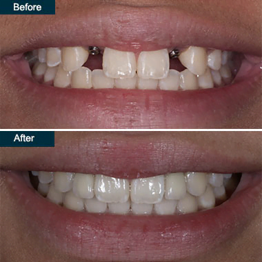 Dental Implant Before and After