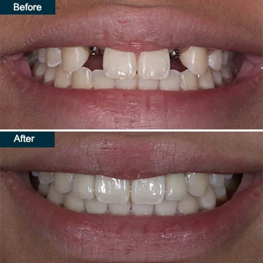 Affordable Dental Implants Downtown NYC - Before and After