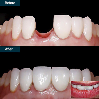 Dental Implant Before and After