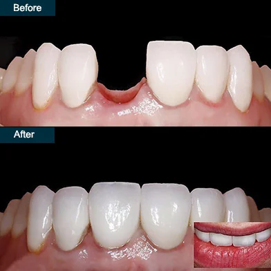 Teeth Implants Lower Manhattan - Before and After