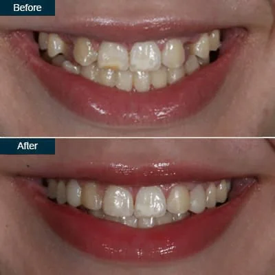 Before and After Tooth Bonding Procedures