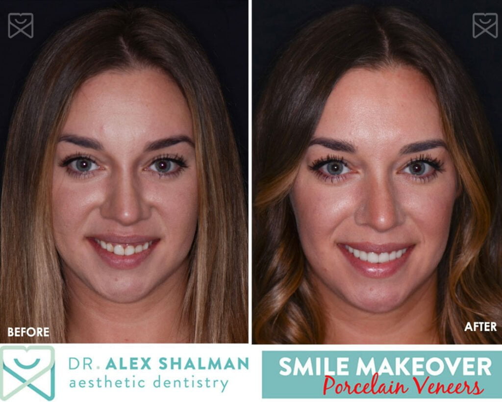 Porcelain Veneers Lower Manhattan Dental Veneers New York