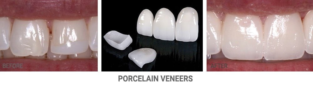 Porcelain Veneers Process
