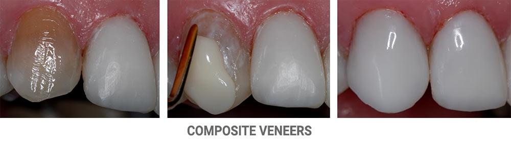 Composite Veneers