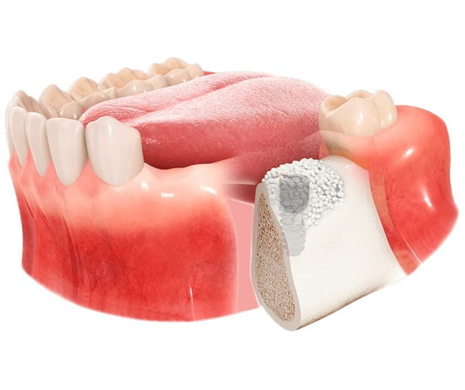 Bone Graft