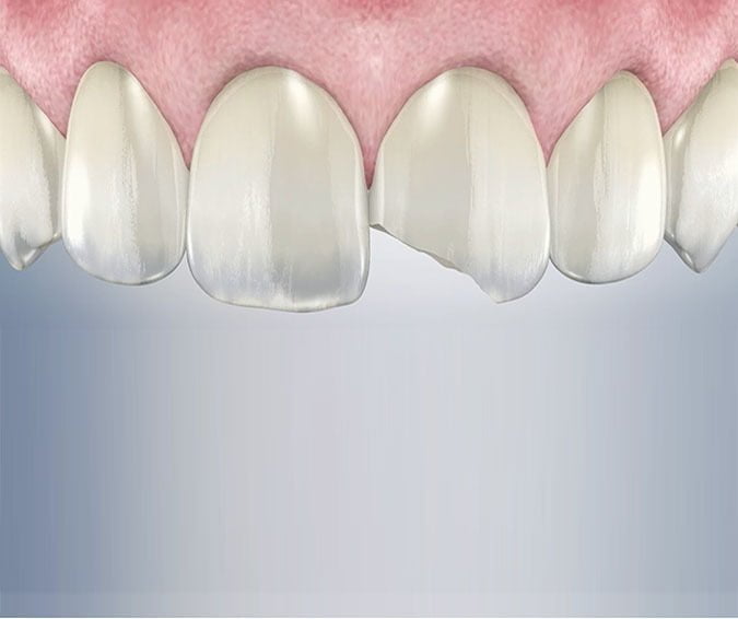 Broken Tooth