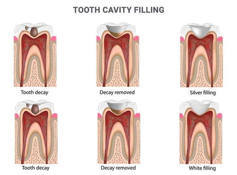 What is a Cavity Filling? - Keep 28 Dental