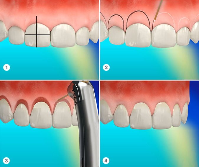 Crown lengthening in Lower Manhattan