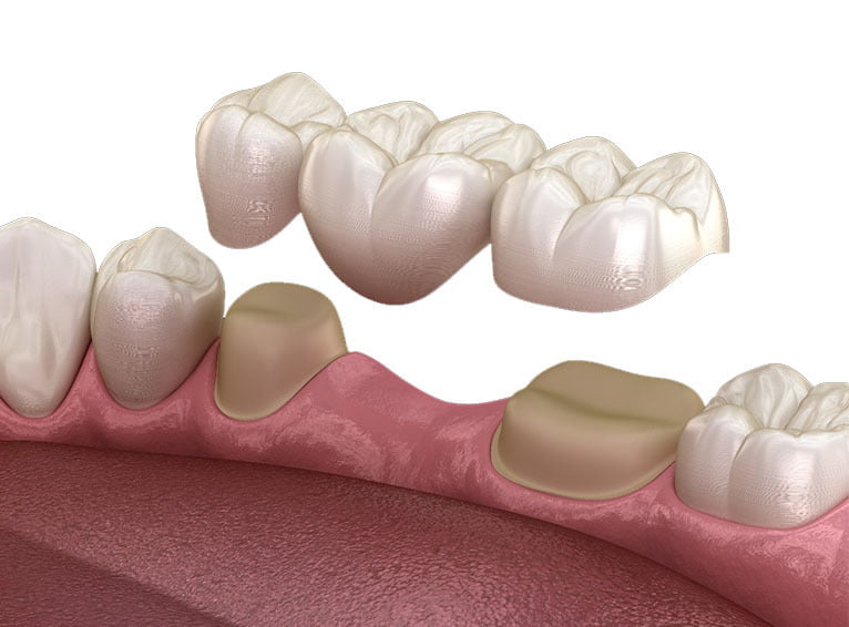 Dental Bridge