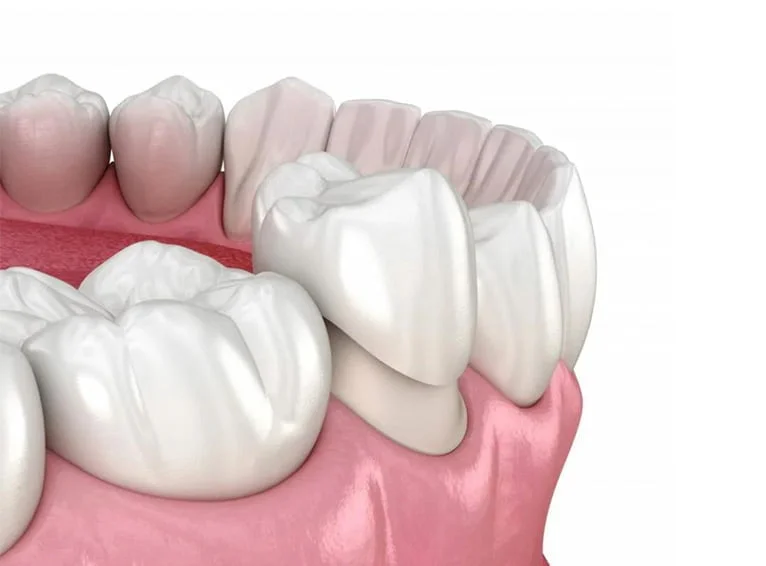 Dental Crown