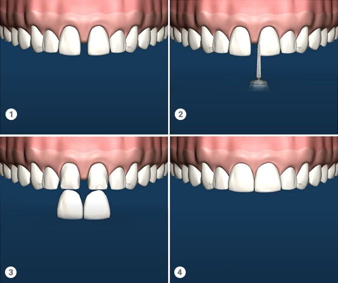 Dental Veneers