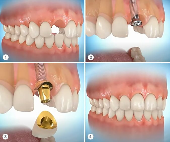 Dental Implants