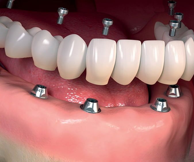 Denture Implants