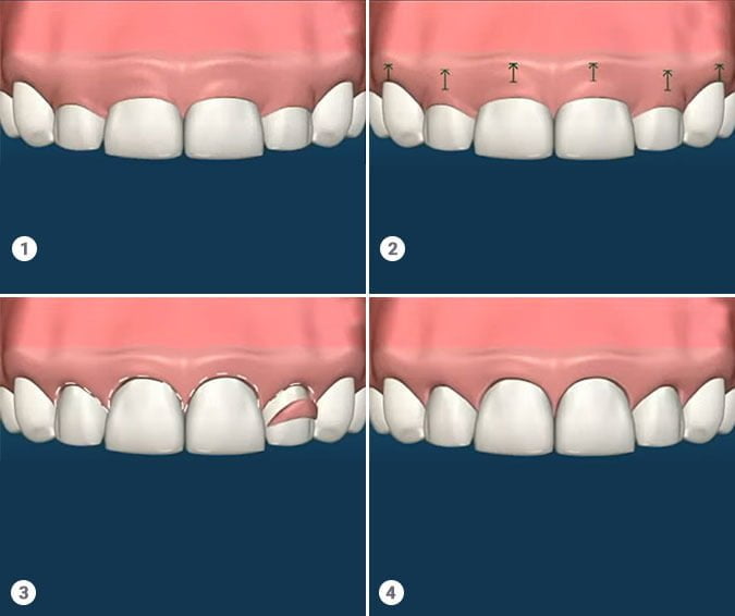 Gum contouring