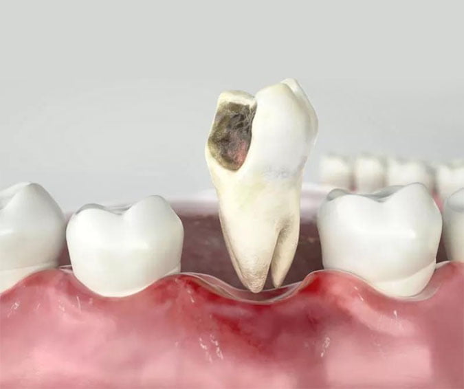 Hole in a tooth