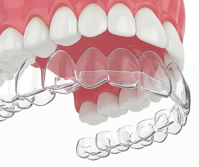 Invisalign