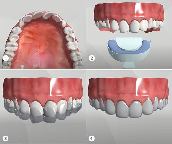Invisalign Process