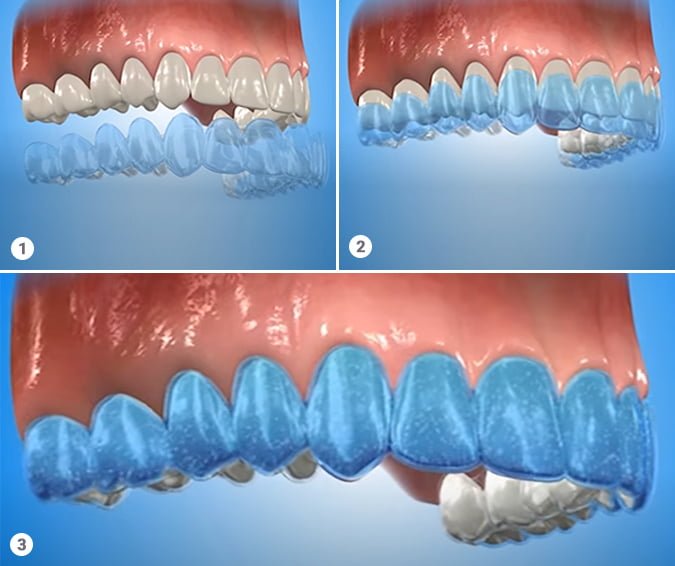 KOR-SEAL Teeth Whitening