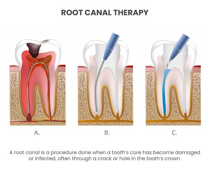 Root Canal Therapy lower manhattan