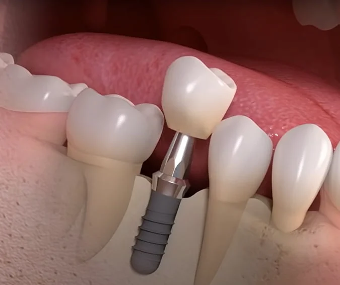 Single Tooth Implant