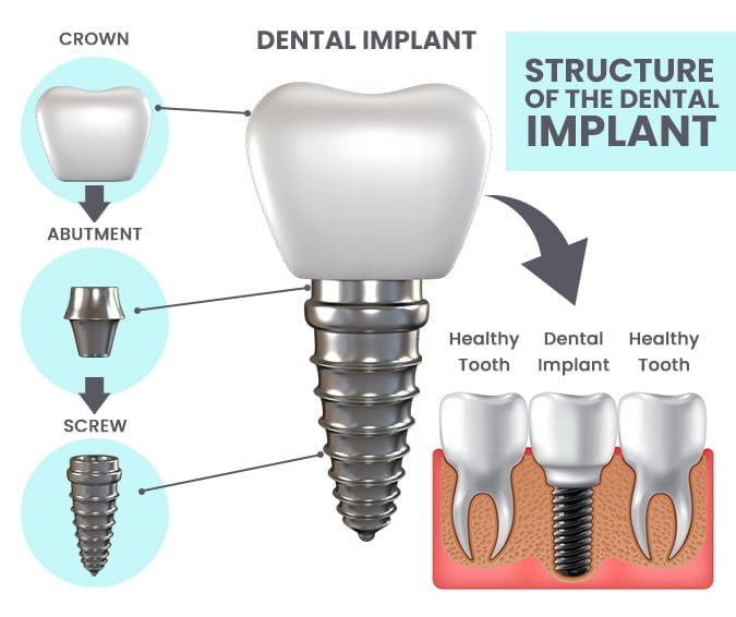 Structure of the dental implant
