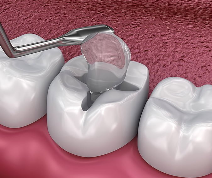 Tooth Filling