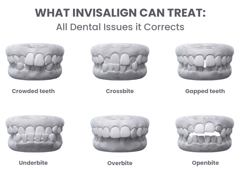 Invisalign in Lower Manhattan