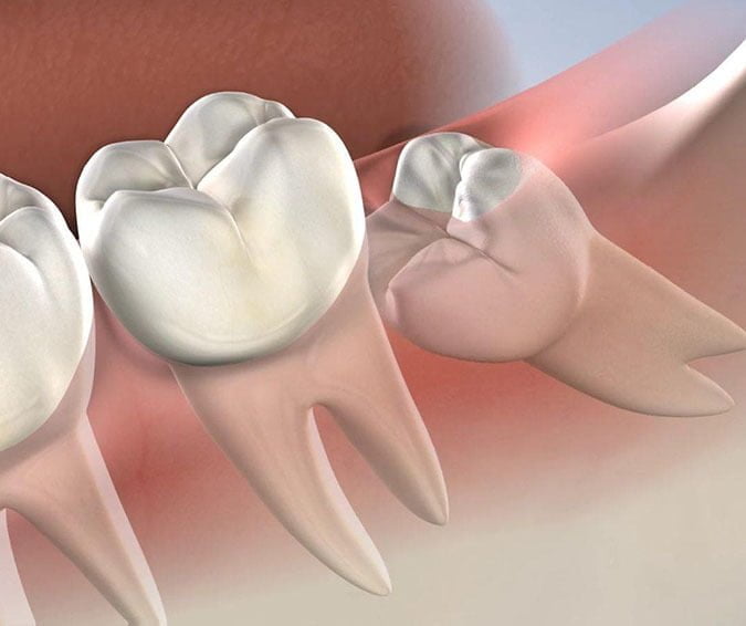 Tooth Extraction in Manhattan