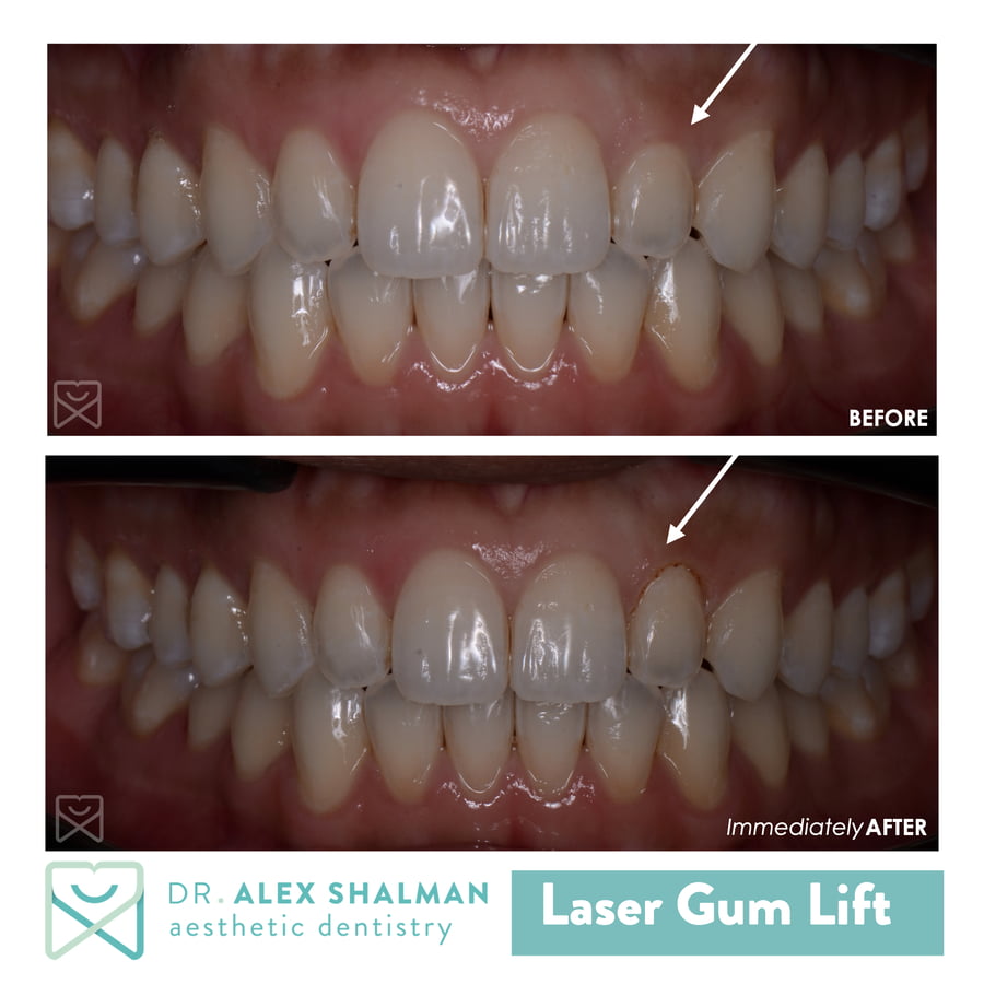 14. Laser Gum Lift b