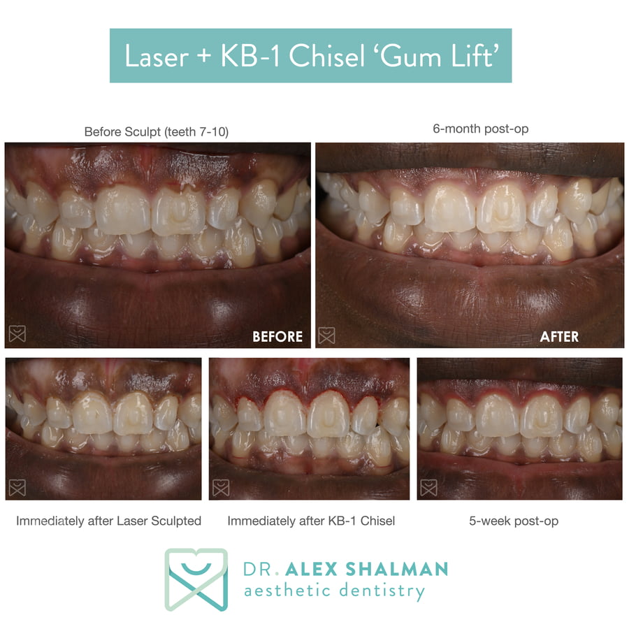 15. Laser Gum lift