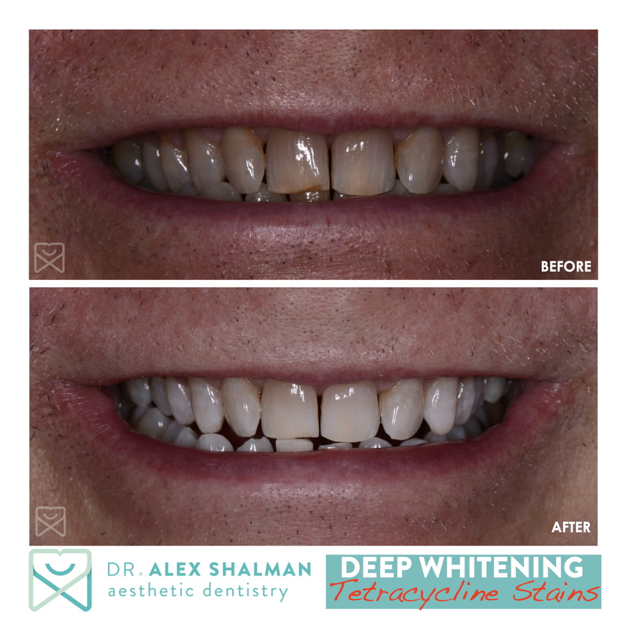 22. Deep Whitening - KoR Whitening - Tetraycycline Stains b