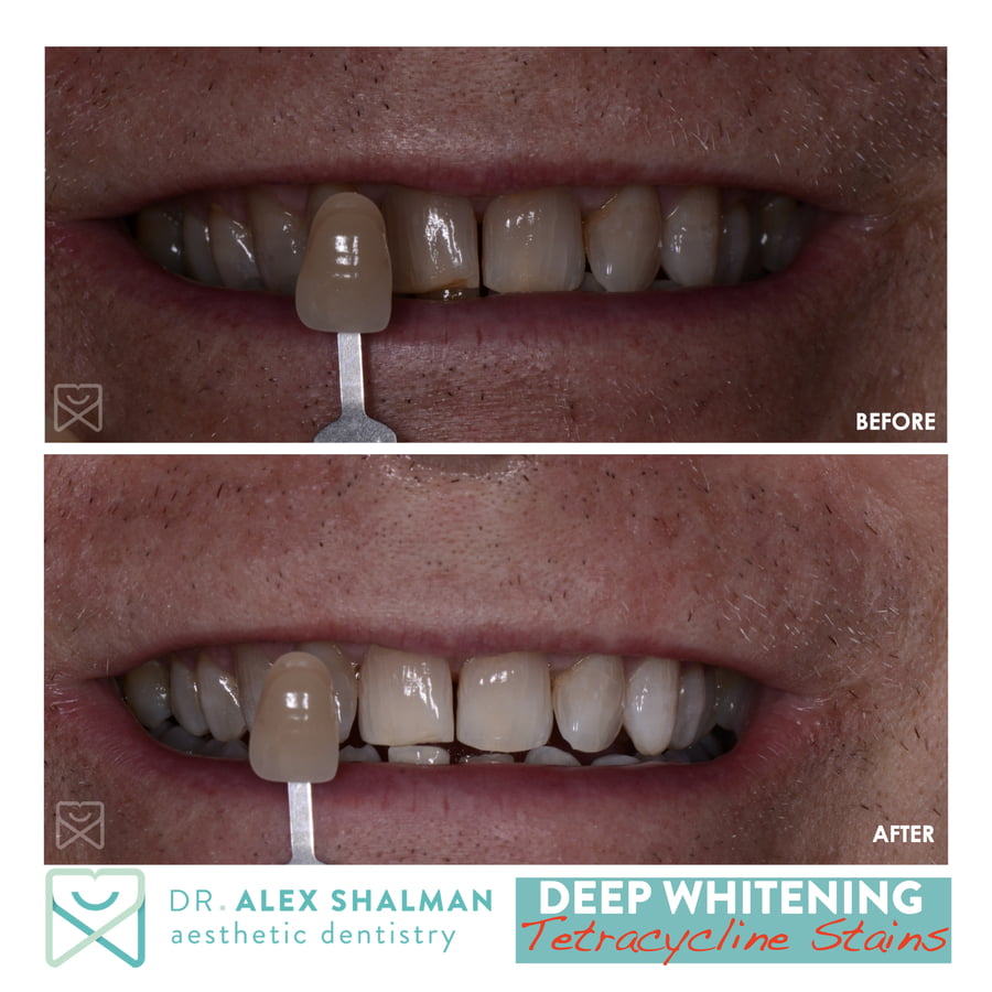22. Deep Whitening - KoR Whitening - Tetraycycline Stains