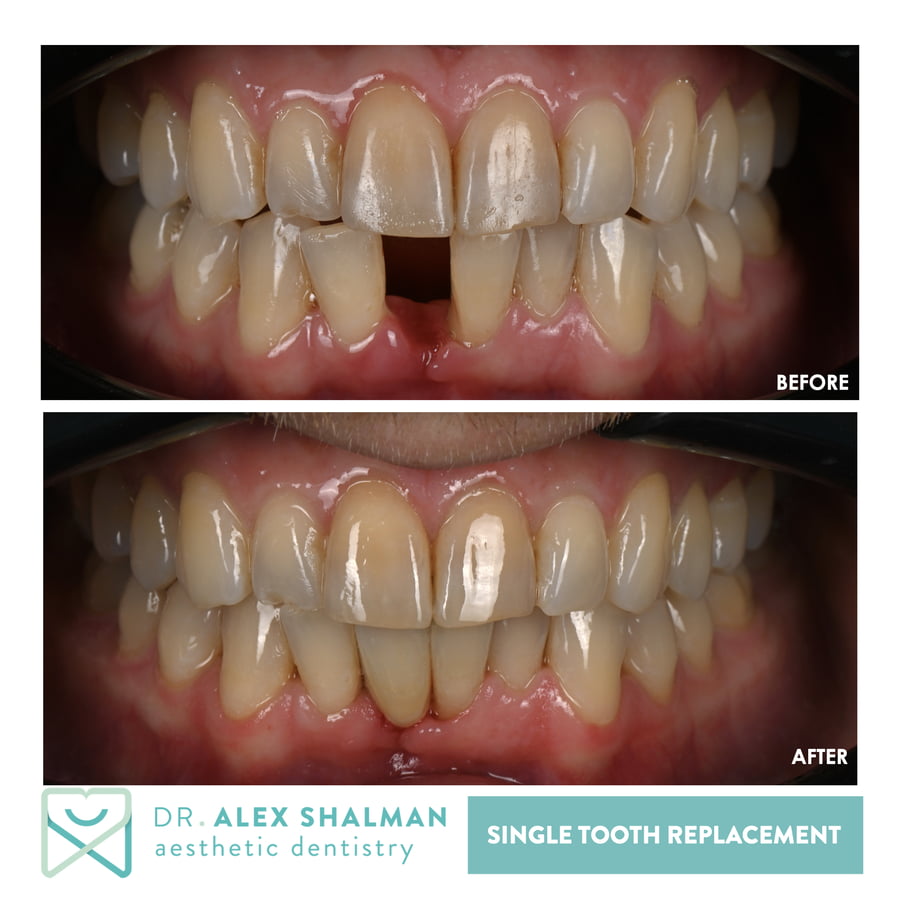 40. Single Tooth Replacement - Porcelain Maryland Bridge