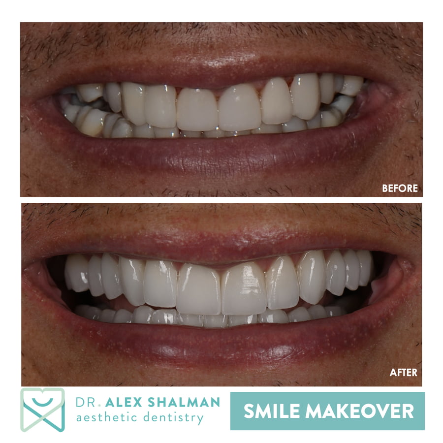 42. Smile Makeover - Full Mouth Rehab, Veneers, Crowns, Onlays, Implants b