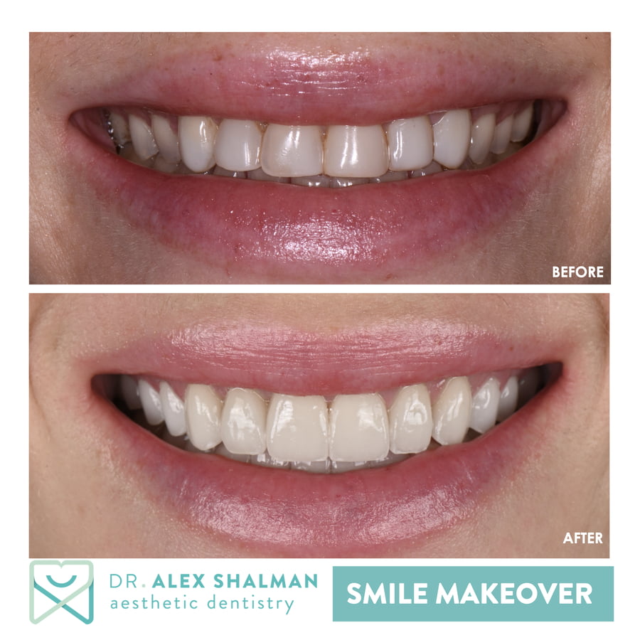 47. Smile Makeover - Full Mouth Rehab, Veneers, Crowns, Onlays, Implants b
