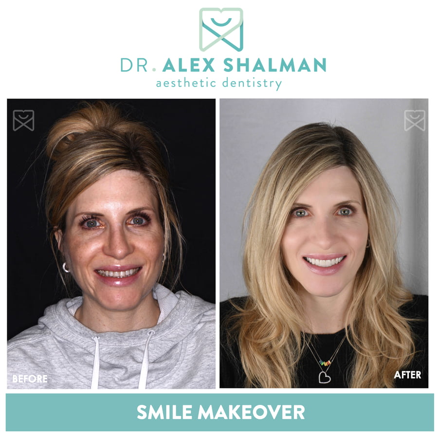 47. Smile Makeover - Full Mouth Rehab, Veneers, Crowns, Onlays, Implants