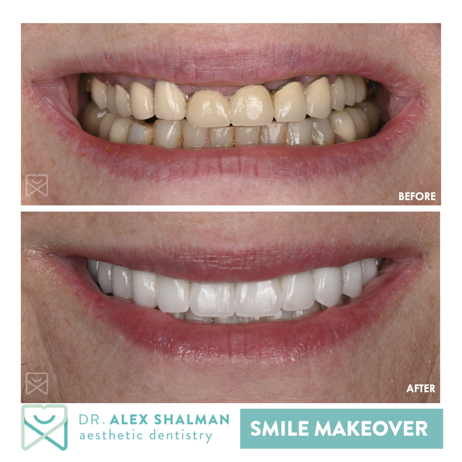 48. Smile Makeover - Full Mouth Rehab, Veneers, Crowns, Onlays, Implants b